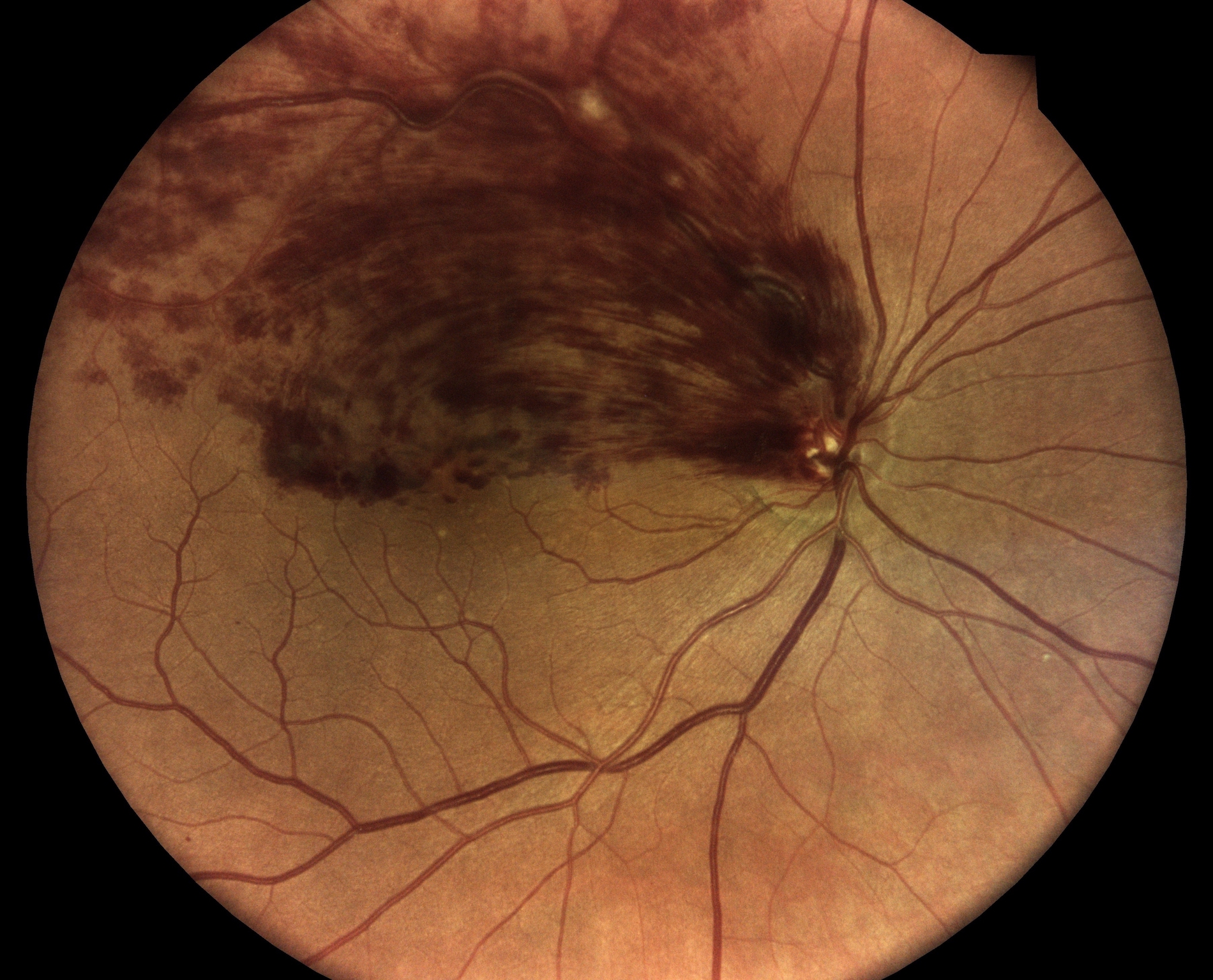 Retinal Vein Occlusion Orlando Retina Consultants Of Orlando