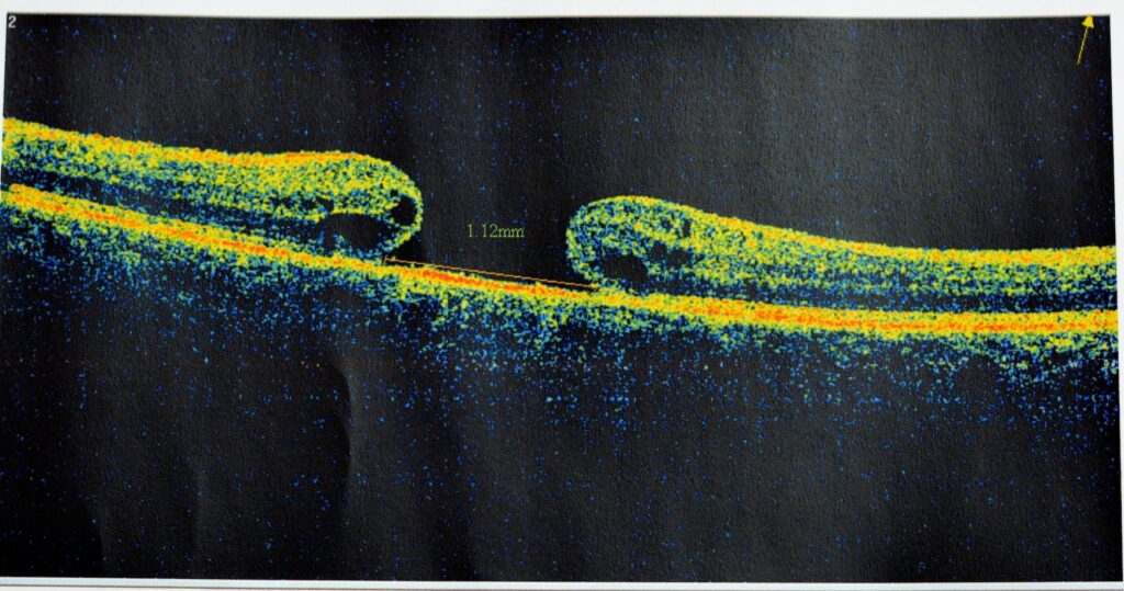 OCT of the eye reveals faint epimacular membrane and full thickness macular hole involving the fovea, surrounding diffuse macular oedema showing few cystoid changes for follow up, selective focus