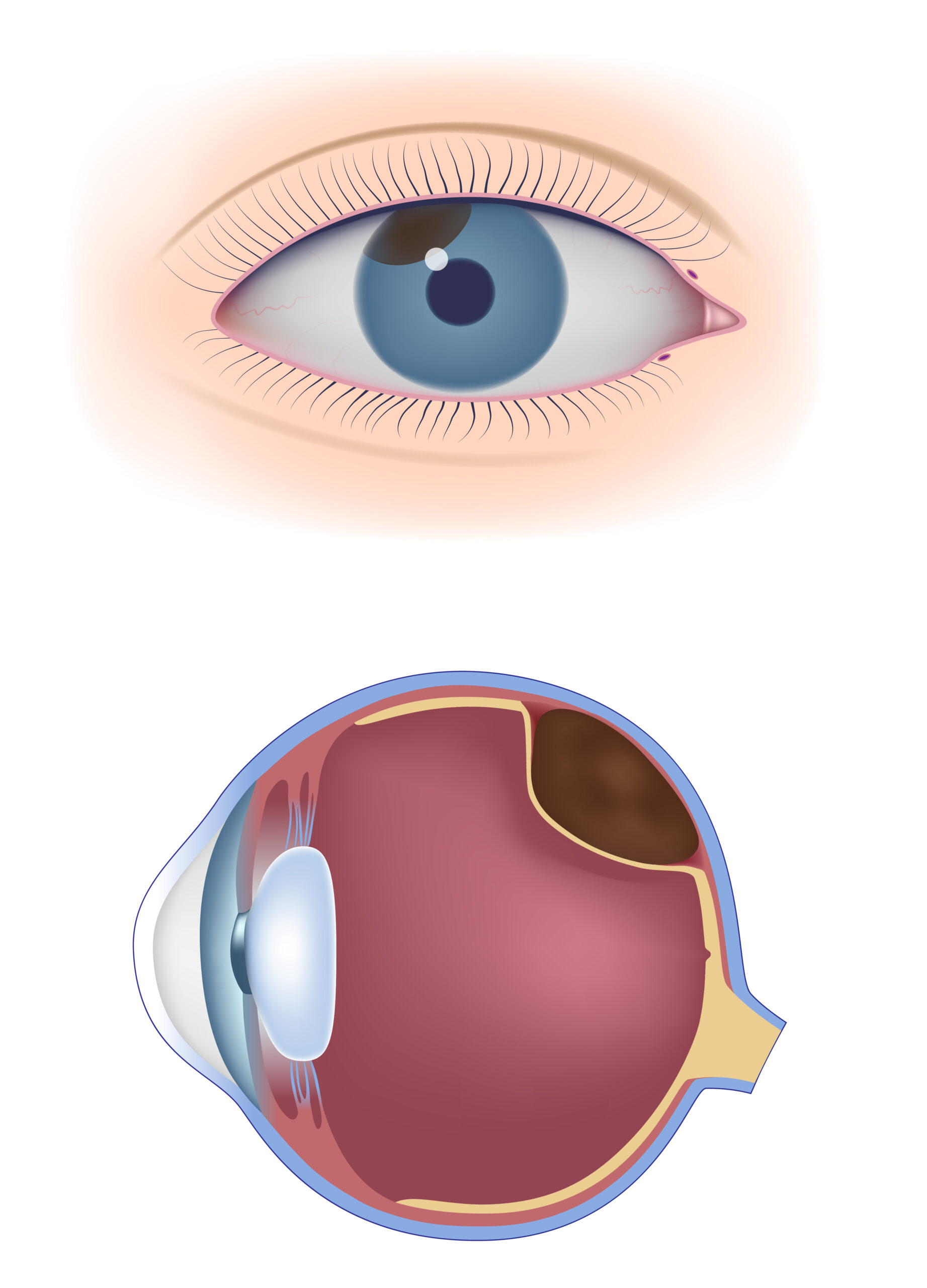 Choroidal Nevus and Uveal Melanoma | Retina Consultants of Orlando