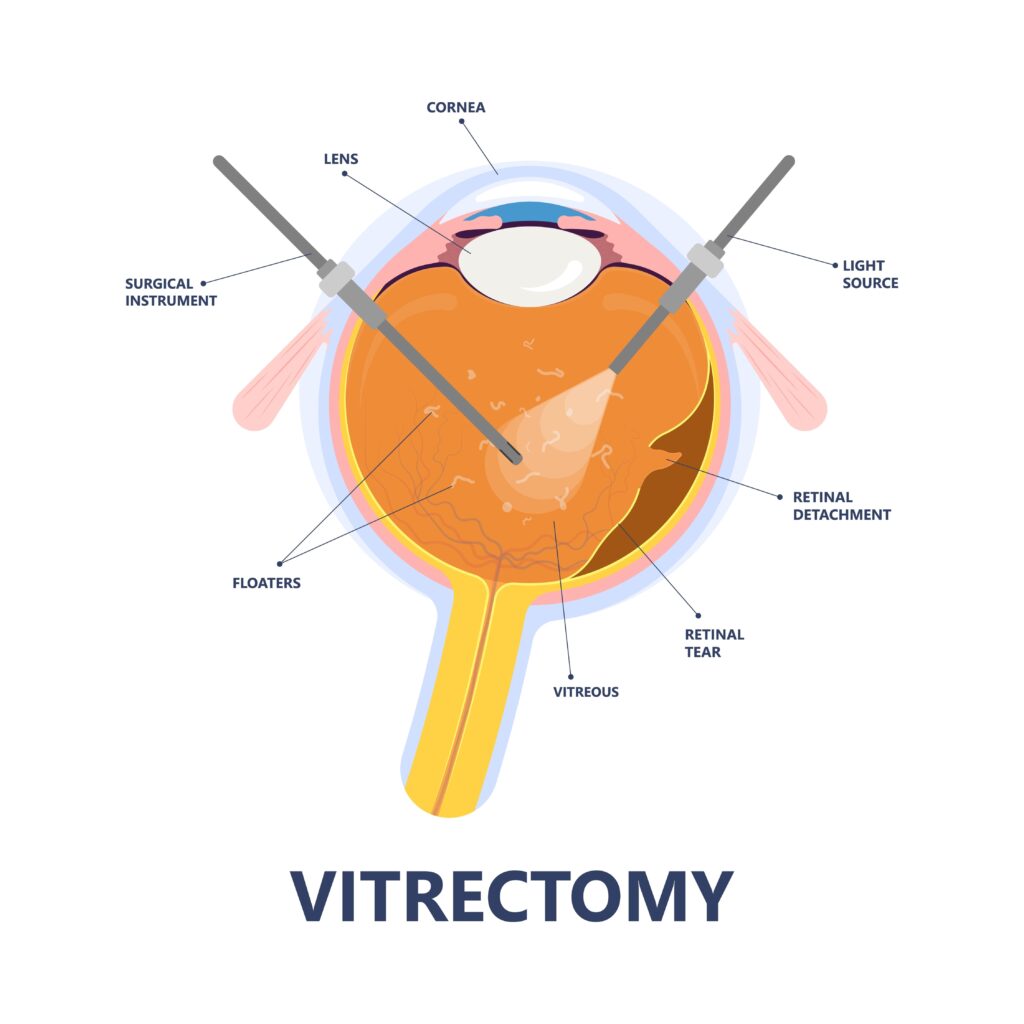 vitrectomy illustration
